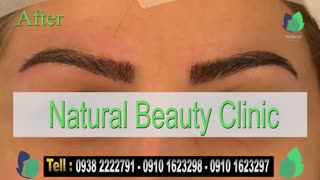 نمونه کار کاشت ابرو- قبل و بعد از کاشت !!!- نچرال بیوتی