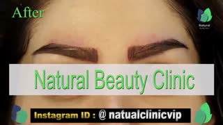 نمونه کار کاشت ابرو- قبل و بعد از کاشت !!!- نچرال بیوتی