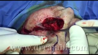 تومور وسیع پلک تحتانی با درگیری گوشه داخلی چشم