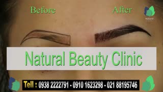 نمونه کار کاشت ابرو- قبل و بعد از کاشت !!!- نچرال بیوتی