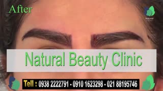نمونه کار کاشت ابرو- قبل و بعد از کاشت !!!- نچرال بیوتی