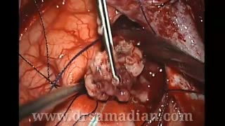 برداشتن میکروسکوپی تومور گلیوم مغزی در یک کودک 8 ساله