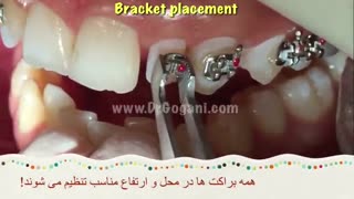 مراحل ارتودنسی : جلسه شروع کار-سیستم MBT