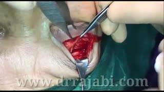 تومور بزرگ در داخل استخوان سقف کاسه چشم