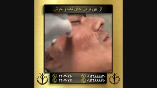 درمان جای لک و جوش - آذر کلینیک لمینت