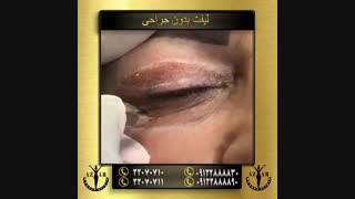 لیفت بدون جراحی در آذر کلینیک