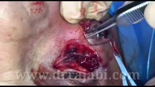 جراحی تومور پلک تحتانی