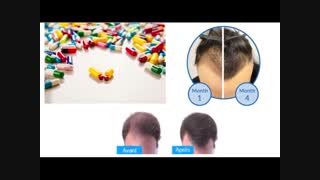 درمان داروئی