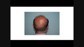 نتایج نامناسب در کاشت مو