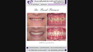 ارتودنسی ثابت | دکتر فاضل فیروزی دکتر پوست