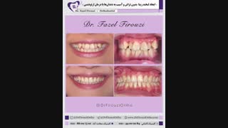 لبخند زیبا با ارتودنسی | دکتر فاضل فیروزی ماموپلاستی