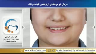قبل و بعد ارتودنسی دیپ بایت | دکتر مسعود داوودیان