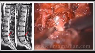 دیسک فارلترال L4- L5