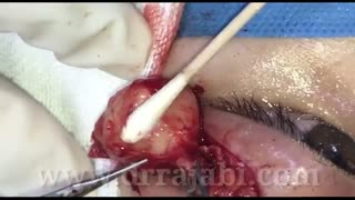 جراحی خارج کردن تومور بزرگ غده اشکی