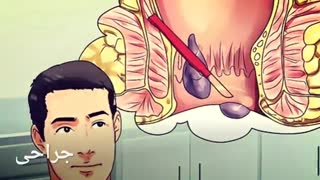 درمان میشه بدون جراحی www.castelinagold.com