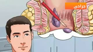 درمان میشه بدون جراحی www.castelinagold.com