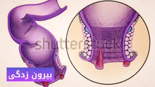درمان قطعی خونریزی مقعد www.castelinagold.com