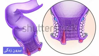 درمان قطعی خونریزی مقعد www.castelinagold.com