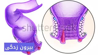 درمان قطعی خونریزی مقعد www.castelinagold.com