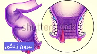درمان قطعی خونریزی مقعد www.castelinagold.com