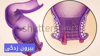 درمان قطعی خونریزی مقعد www.castelinagold.com
