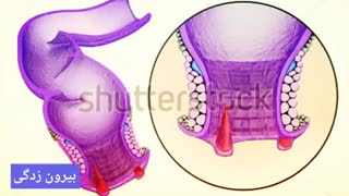 درمان قطعی خونریزی مقعد www.castelinagold.com