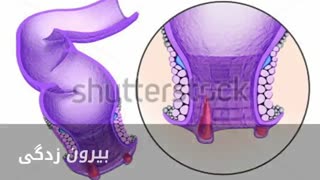 درمان قطعی خونریزی مقعد www.castelinagold.com