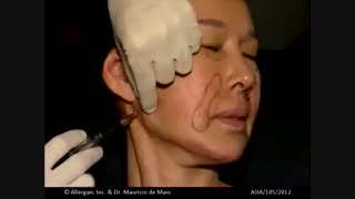 لیفت 8 قسمت از صورت با ژل ژوویدرم