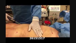لیپوماتیک - دکتر ابدالی - 22807060 پیلینگ