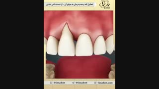 تحلیل لثه | دندانپزشکی سیمادنت
