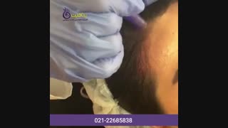 درمان ریزش مو با مزونیدلینگ