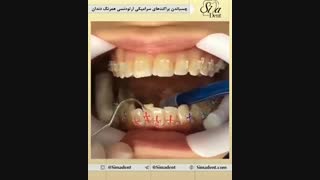 براکت ارتودنسی | دندانپزشکی سیمادنت