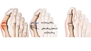 درمان باور نکردنی انحراف قوزک انگشت شست پا