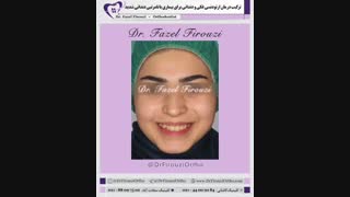 درمان ترکیبی ارتودنسی | دکتر فاضل فیروزی ماموپلاستی