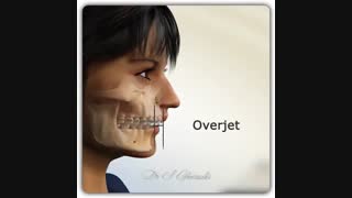 orthognathic Surgery in class ll patient | dr.saeed ghorashi