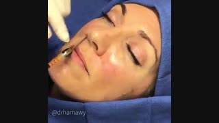 تزریق چربی به صورت رفع غبغب