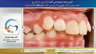 ارتودنسی ثابت به همراه دستگاه فانکشنال | دکتر مسعود داوودیان
