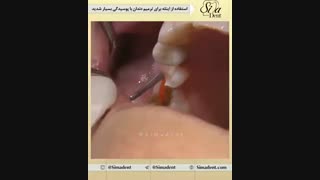ترمیم اینله در پوسیدگی دندان | دندانپزشکی سیما دنت