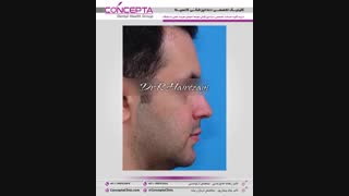 درمان ارتودنسی ثابت بدون کشیدن دندان | دکتر حاج رضایی آر اف فرکشنال