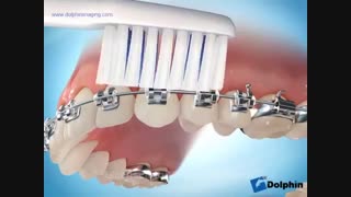 نحوه صحیح مسواک زدن در حین درمان ارتودنسی - متخصص ارتودنسی