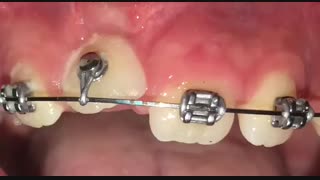 رویاندن دند ان با ارتودنسی