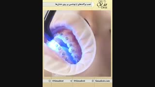 نصب براکت های ارتودنسی | دندانپزشکی سیمادنت