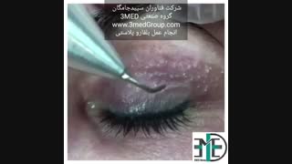 پلاسما تراپی