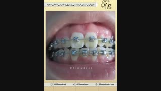 درمان ارتودنسی ثابت | دندانپزشکی سیمادنت