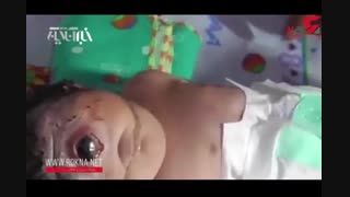 وحشت پزشکان از تولد این نوزاد تک چشم