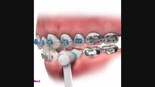 شکستن براکت ارتودنسی و خم شدن سیم ارتودنسی