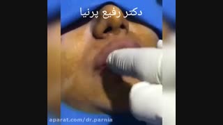 تزریق ژل لب لیپوماتیک