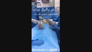 لیپوماتیک لیزر موهای زائد