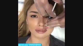 تزریق ژل در لب بررسی لک صورت