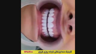 ونیر دندان و دندان های زیبا و یکدست